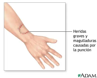 Mordeduras humanas.