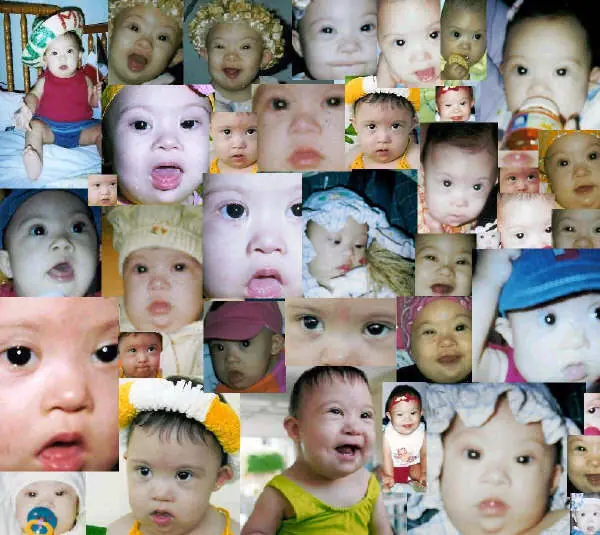 El sindrome de down.