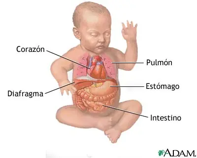 Hernia diafragmática
