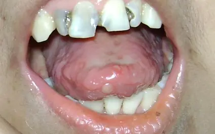 Como Curar la Herpe En La Lengua