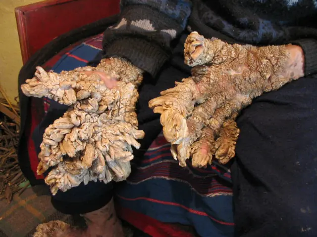 Extraña Enfermedad de la Piel - El Hombre Árbol