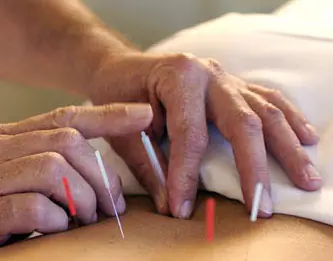 Acupuntura China