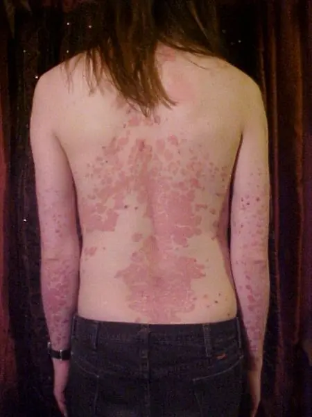 Como curar la psoriasis