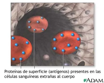 Reacción a una transfusión