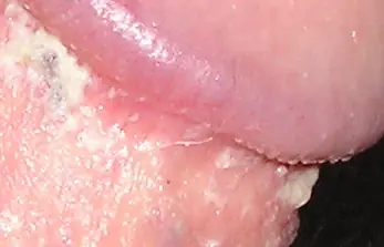 Granitos alrededor del Pene .... Glándulas de Tyson.