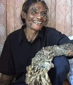 El hombre árbol Entra!!