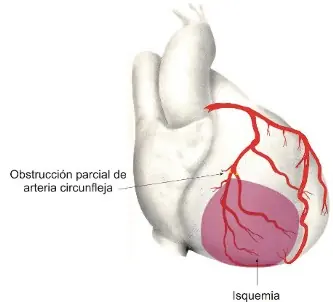 Aterosclerosis: ¿Cómo y por qué afecta al corazón?