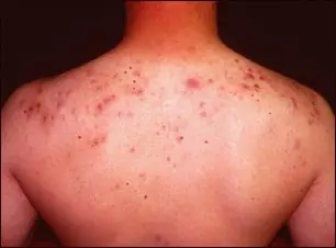 Granitos en la espalda