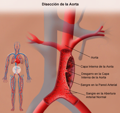 Qué es la disección aórtica?