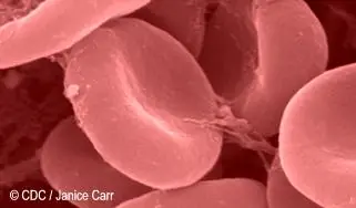 Gran avance contra el SIDA