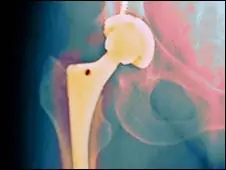 Nueva técnica para regenerar articulaciones