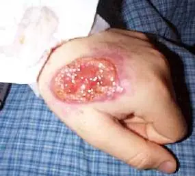 Leishmaniasis: Megapost
