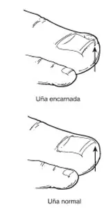 Uña Encarnada del Dedo del Pie