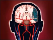 Enfriar el cerebro podría ayudar a recuperarse de un derram