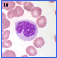 anemia