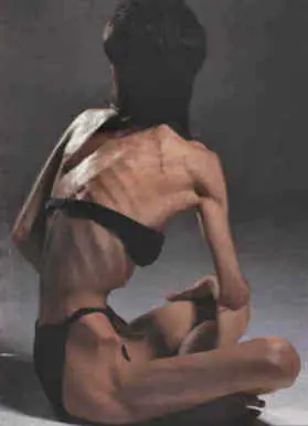 Informacion Bulimia y Anorexia