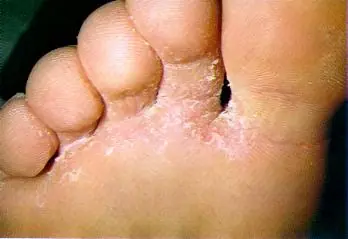 Elimina Los Hongos De Tus Pies