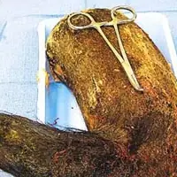 Hallan un gigante "HAIRBALL" en el estómago de un