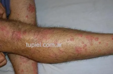 Psoriasis: que es, como se trata y últimas noticias