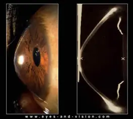 Tenes queratocono?