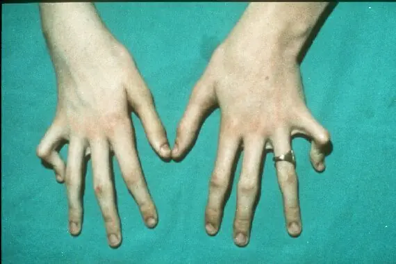 El Sindrome de Marfan