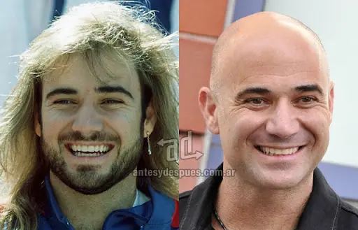Famosos que sufren la caida de el pelo