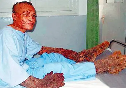 El hombre arbol extraño caso!