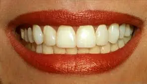 Complicaciones de los implantes dentales
