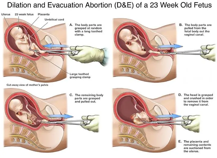 Aborto