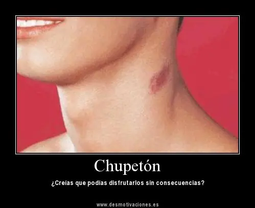 10 Trucos Para Quitar Un Chupon