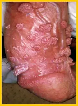 Virus de papiloma en el Hombre (HPV)
