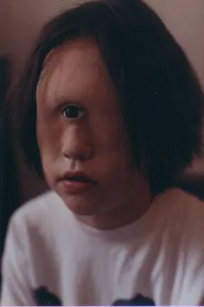 Niño Cyclope Subnormal