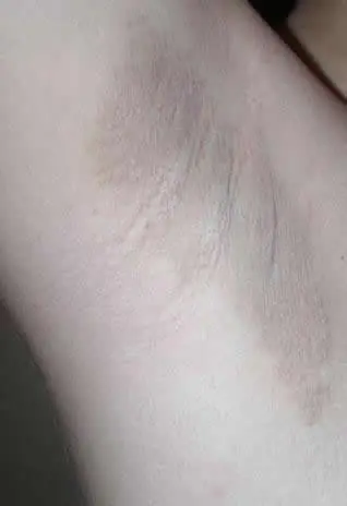 ¿Cómo eliminar las manchas de las axilas?