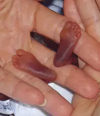 El bebe mas pequeño del mundo