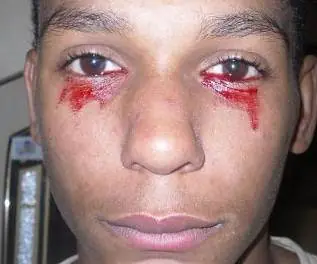 Lágrimas de Sangre: Joven Llora Sangre