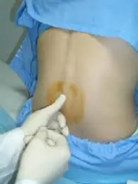Cuidado con el Herpes cerebral