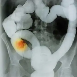 Cancer de colon