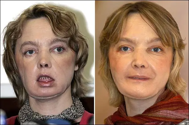 Trasplantes de rostro