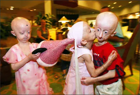 Progeria: El síndrome de Hutchinson-Gilford o Niños Viejos