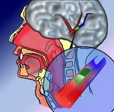 Sintomas De La Embolia, estas mas cerca de lo que crees !!!