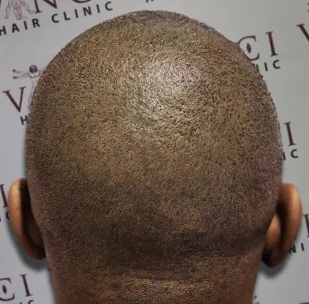 Se tatuan pelo