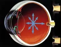 Glaucoma y Presion intraocular MEGAPOST