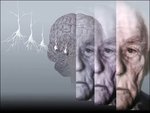 las verdaderas causas del Alzheimer y el Parkinson