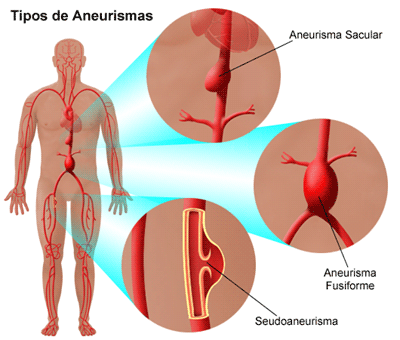 Qué es un aneurisma?