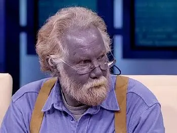 Extraña patología, gente con piel azul