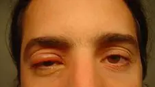Remedios Caseros para el orzuelo en el ojo