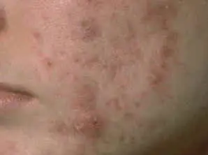 disminuir marcas de acné