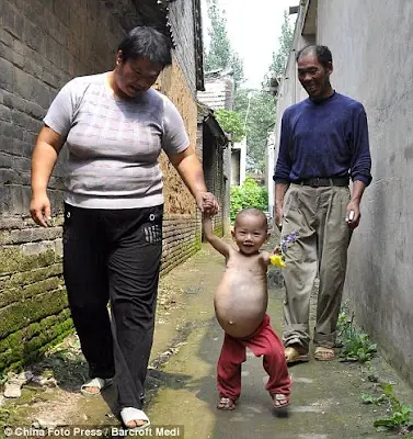 Kang Mengru Fetus in feto