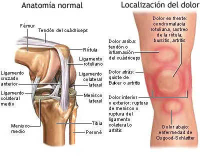 ¿Qué es la Condromalacia Rotuliana?