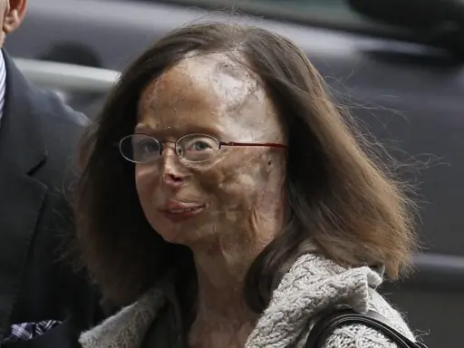 Foto impactante: Desfigurada por su novio